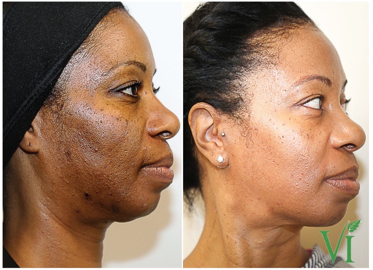 Hyperpigmentation - Causes, Care & Prevention | Women Of Color - Beautizone UK